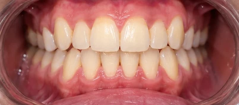Crowded teeth, after treatment