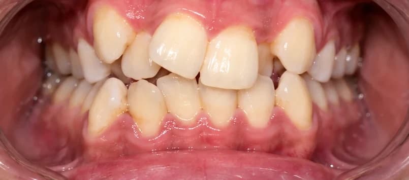 Crowded teeth, before treatment