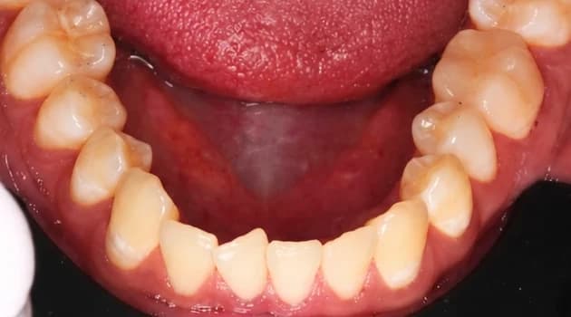 Crowding teeth, before treatment