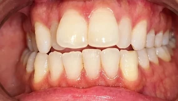 Crowding teeth, before treatment