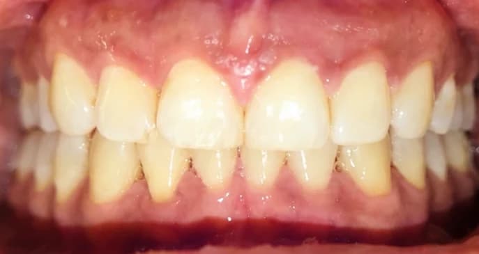 Midline diastema, after treatment