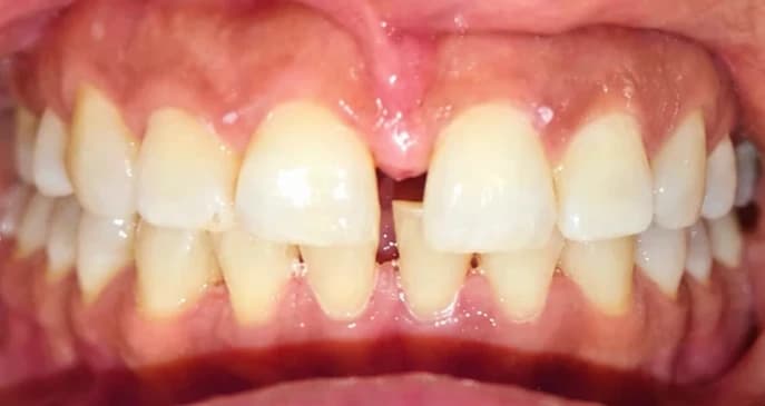 Midline diastema, before treatment