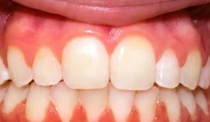Overbite, after treatment