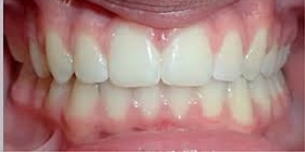 Before Aligner Treatment 1