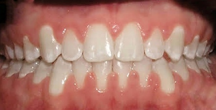 Before Aligner Treatment 2