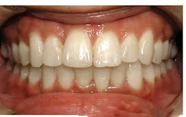 Before Aligner Treatment 1