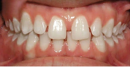 After Aligner Treatment 2