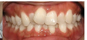 After Aligner Treatment 1