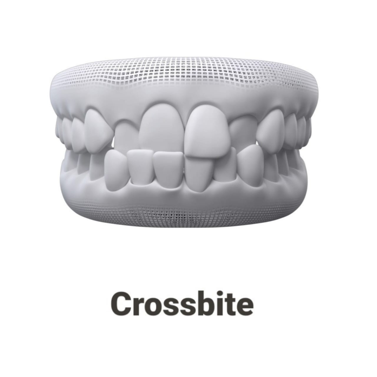 Crossbite