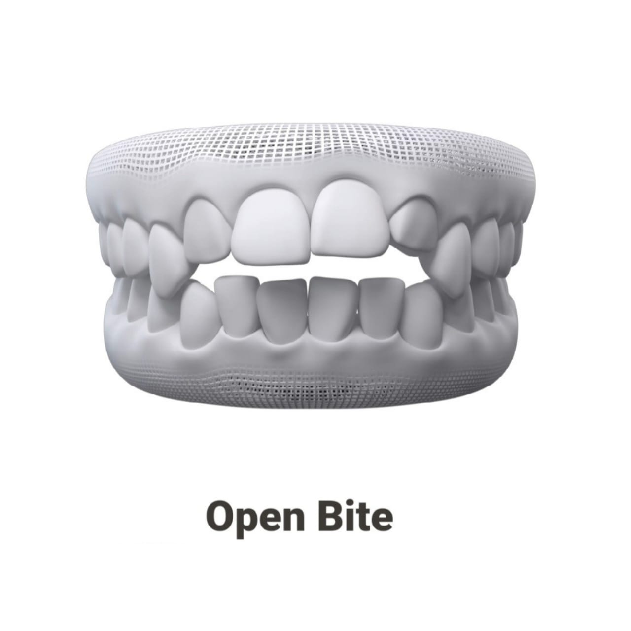 Open Bite