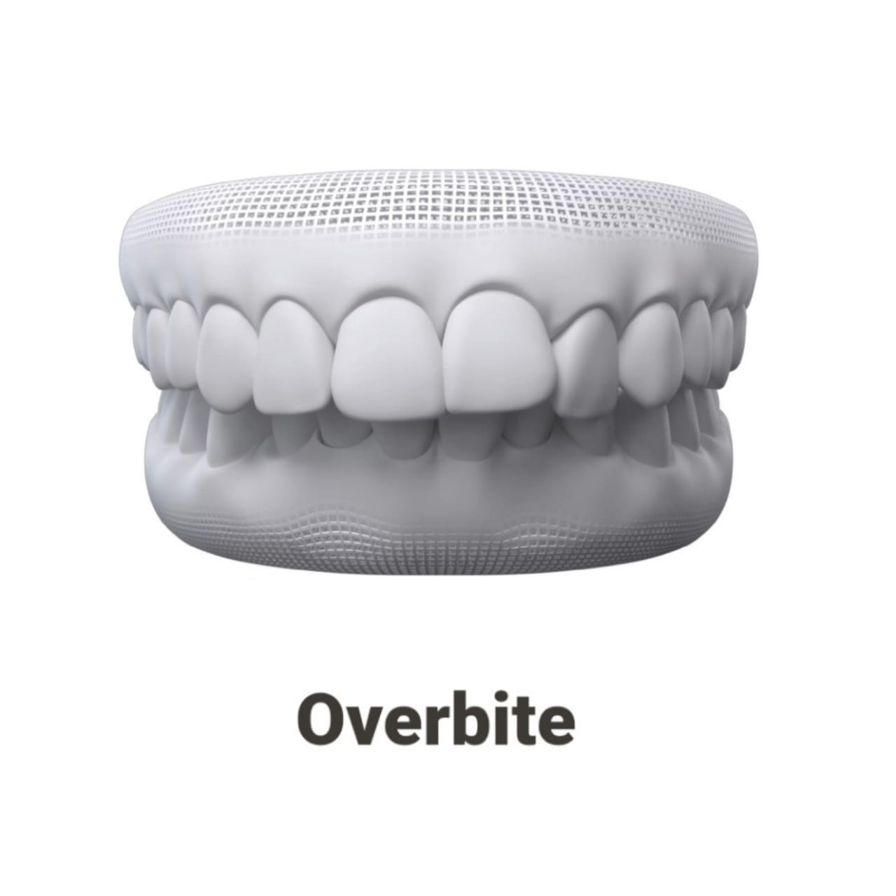 Overbite