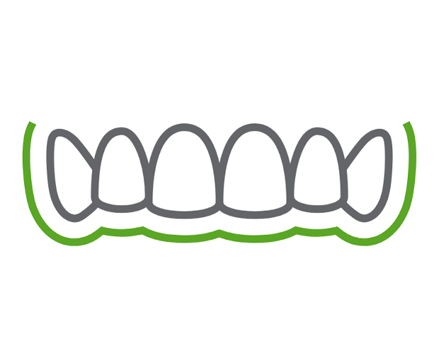 Removable Aligners